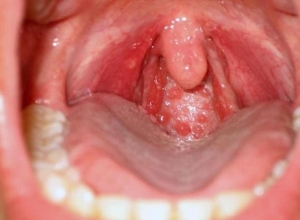 Nguyên nhân nào gây ung thư vòm họng? Tìm hiểu ngay để biết